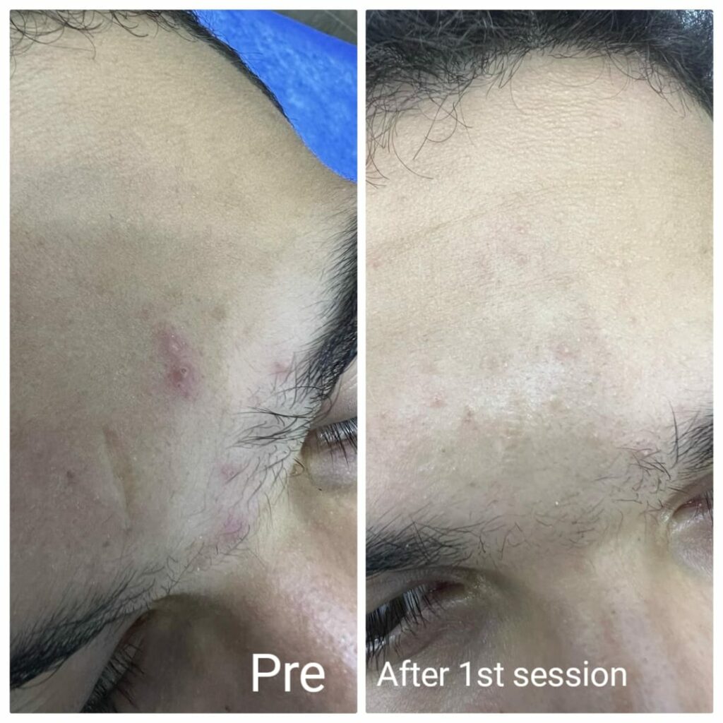 علاج آثار الندوب بعد جلسة واحدة